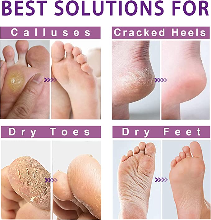 Best Way to Remove Dead Skin From Your Feet